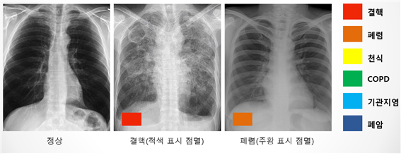 DxRAD가 판독해 보여주는 흉부영상 사진 예시 (사진 = MID 제공)